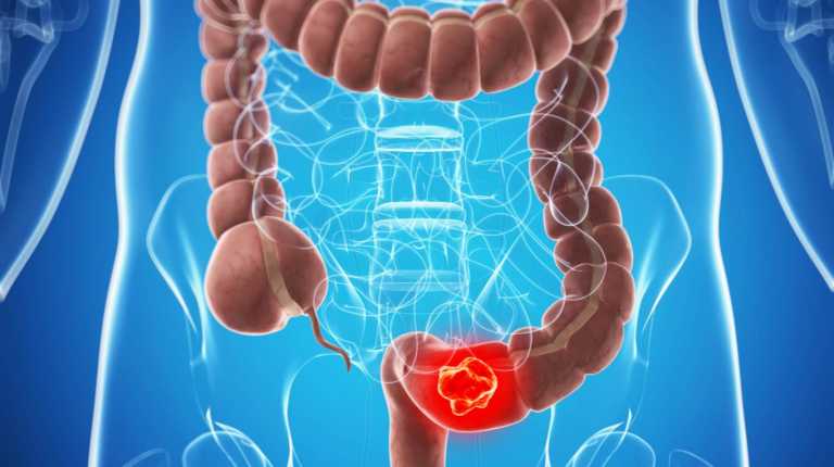 10 Warning Signs of Colon Cancer You Should Not Ignore - Huffington News