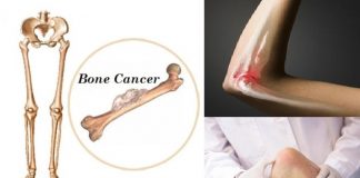 Symptoms of Bone Cancer