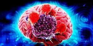 symptoms of Brain Cancer