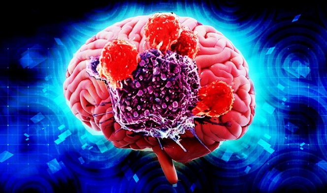 symptoms of Brain Cancer