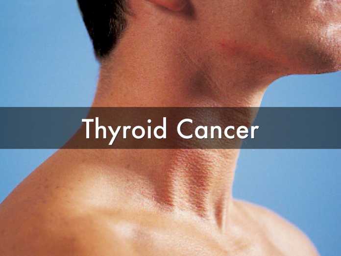 Thyroid Cancer signs