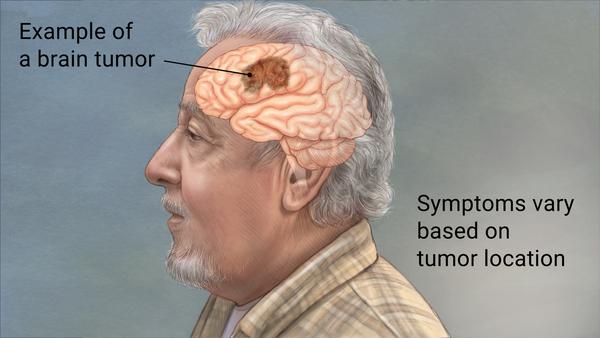 symptoms of brain tumors