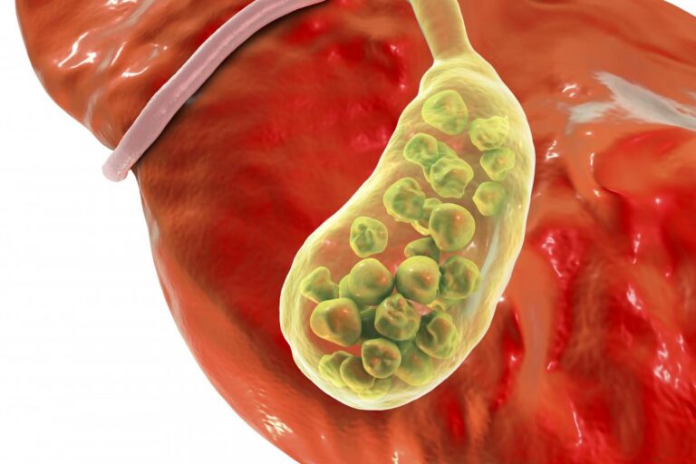 How to Recognize the Symptoms and Signs of Gall Bladder Illness ...