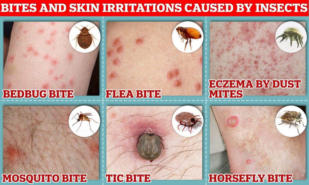 what-s-the-difference-between-bed-bug-bites-vs-mosquito-bites