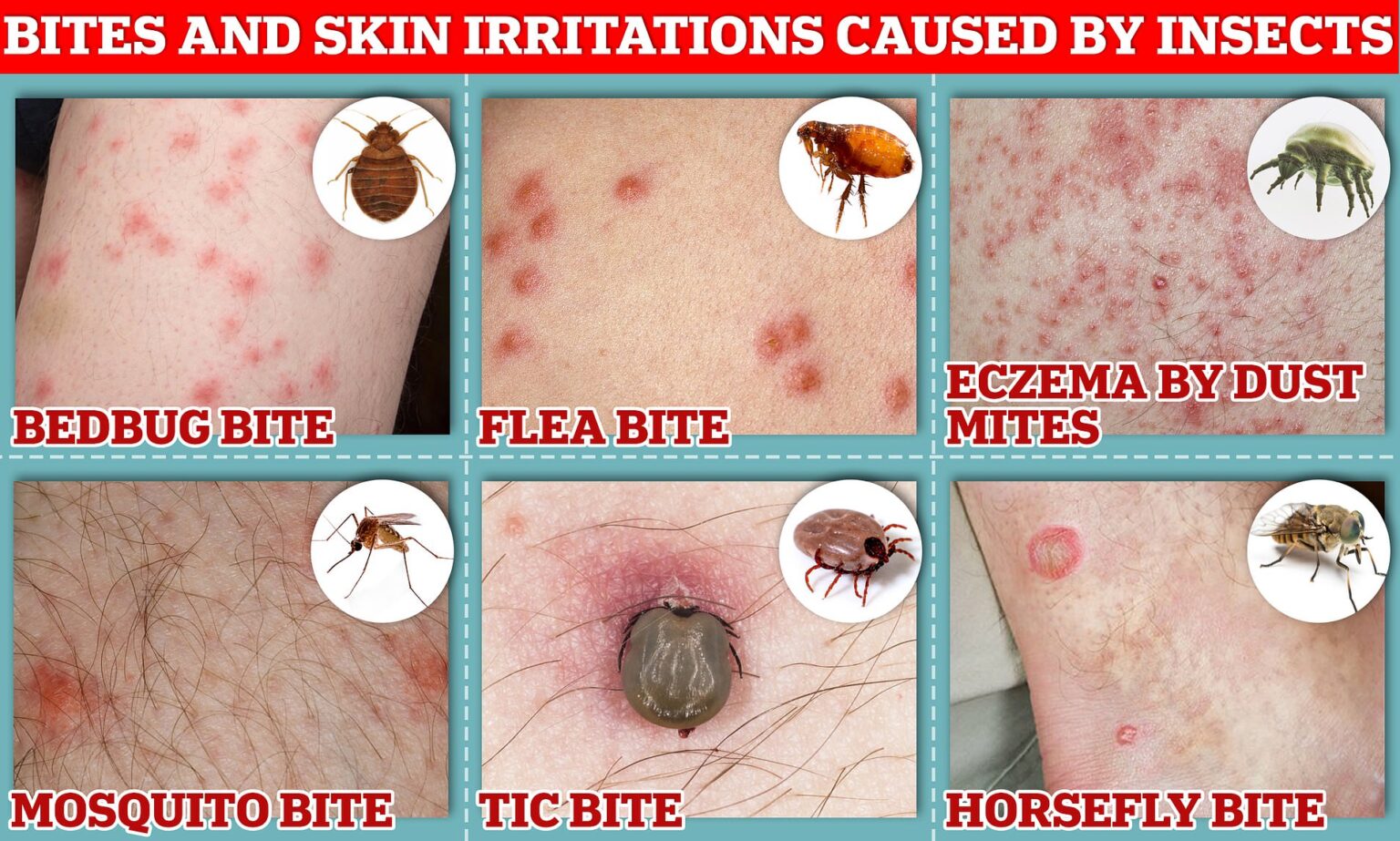 Beware Of Bed Bug Bites How They Can Aggravate Mite Infestations