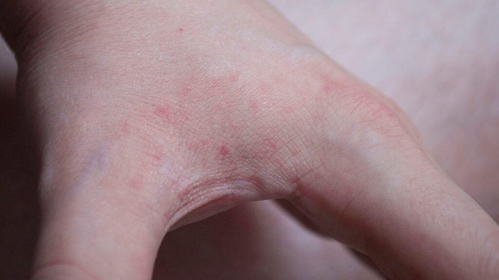 The Itchy Truth: How to Recognize and Treat Bed Bug Bites on Hands ...