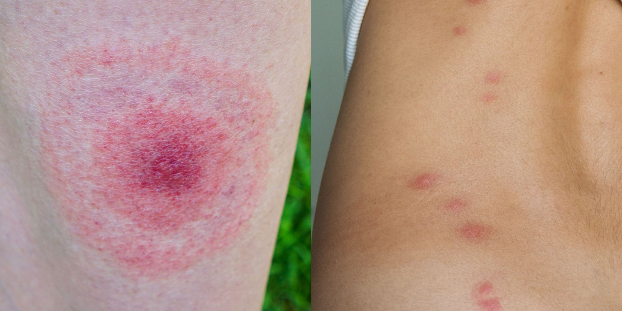 trapped-and-suffering-bed-bug-bites-inflict-pain-on-spiders