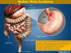 10 Symptoms of Mallory-Weiss syndrome You Should Never Ignore ...